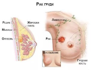 Рак груди